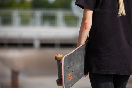Wound on the hand of a skateboarder outdoorsの写真素材