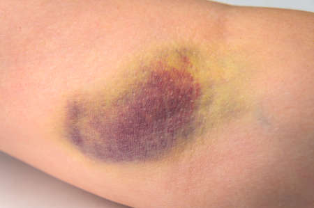 Closeup of a very large bruise on a human arm after a botched blood draw