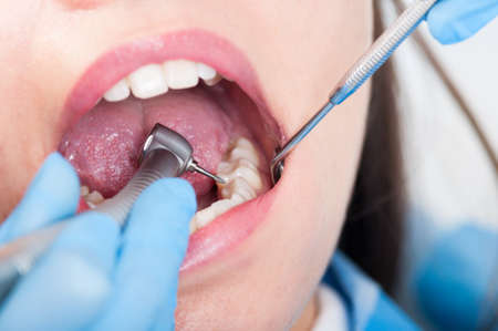 Close-up of dental drill use for patient teeth in dentistry office in a dental treatment procedure