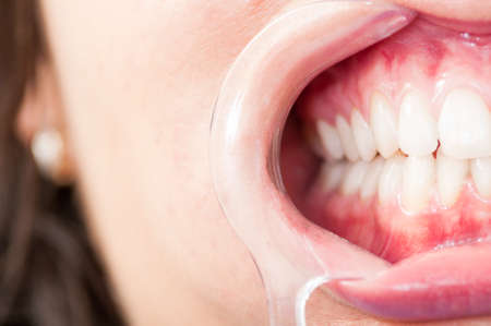 Close-up of half mouth with plastic retractor and teeth in dental office as stomatology treatment...
