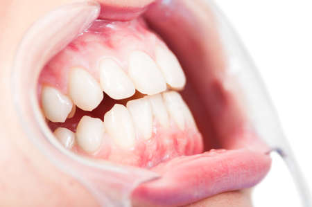 Close-up of side view of female patient cavity and teeth with plastic retractor as orthodontic...