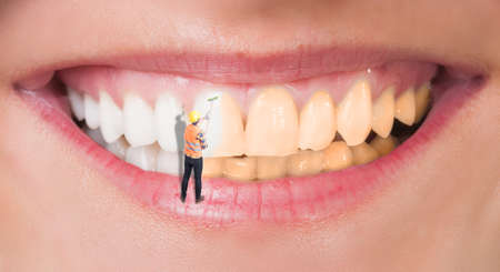 Close-up of perfect smile before and after bleaching as dental whitening concept