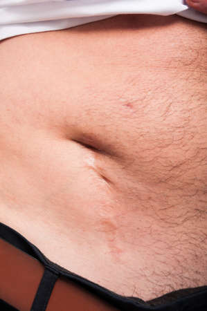 Big old scar after appendicitis surgery or side abdominal appendectomyの写真素材