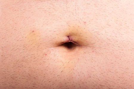 Closeup of belly stitch after laparoscopic surgery of gallbladder removalの写真素材