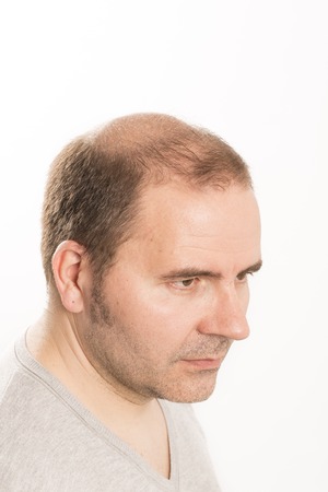 Baldness Alopecia man hair loss haircare medicine bald treatment transplantationの写真素材