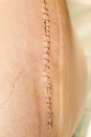 Long scar with staples fasteners and clamp on leg