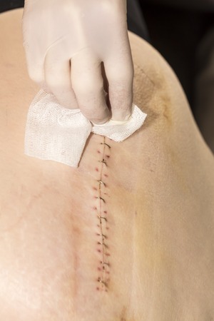 Long scar with staples fasteners and clamp on legの写真素材