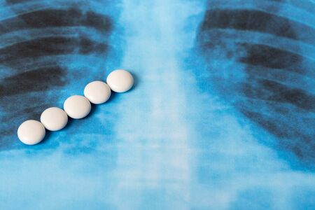 Novel Covid-19, coronavirus. Infected lungs radiology blue image background, with white chloroquine pills on it.の写真素材
