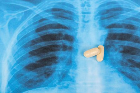 Novel Covid-19, coronavirus. Infected lungs radiology blue image background, with white chloroquine...