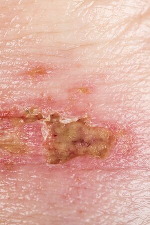 chemical burn on the wrist skin with hydroxide sodium acid, by striping paint from wood. Festering...