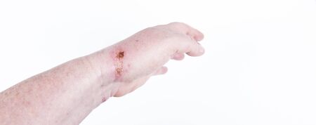 chemical burn on the wrist skin with hydroxide sodium acid, by striping paint from wood. Festering...