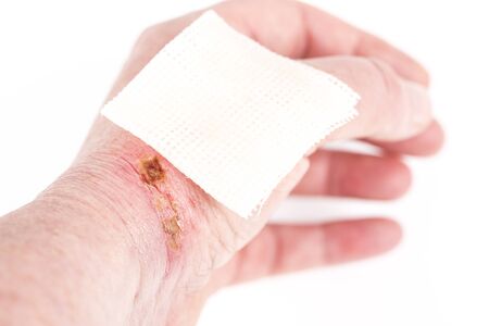 chemical burn on the wrist skin with hydroxide sodium acid. Festering and deep wound. Household accident, because of blue gloves to sharp. Sterile paraffin gauze dressing on it. Selective focus