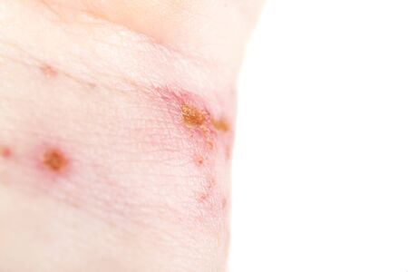 chemical burn on the wrist skin with hydroxide sodium acid, by striping paint from wood. Festering...