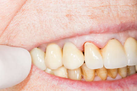 Close up macro shot of interior of mouth and fillings and crowns on teeth, with plaque tartar. Need...