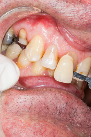 Using a shade guide to check veneer of tooth crown, at dentist office