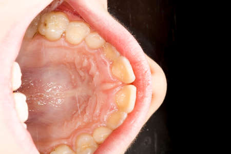 Unhealthy child teenager denture, tartar on frontal teeth