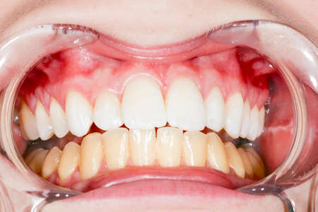 Before and after teeth bleaching or whitening treatment. Close-up of young Caucasian female with...