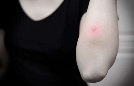The inflammation of the swelling from abscess near womanâs elbow. Selective focus. Black and white toneの写真素材