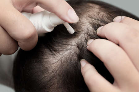 Close up of maleâs hand using medication on scalp, treating for Alopecia, hair loss, dandruff or hair problemの写真素材