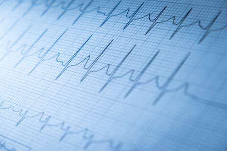 Close up of an electrocardiogram in paper form