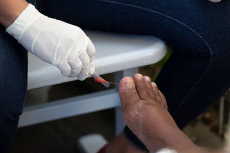 Rio de Janeiro, Brazil - november 22, 2018: Healthcare professional examines the foot of a diabetic patient with a monofilament in a screening campaignのeditorial素材