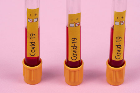 vacuum tube for collecting blood sample with disease label.