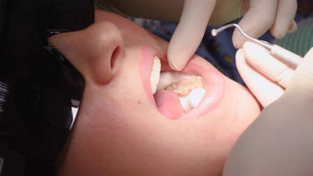 Applying resin based composite filling on tooth. Young woman at dental clinic. Female dentist with assistant treating cavities in a patient mouth in modern dental office.の写真素材