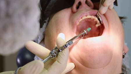 Dentist making local anaesthesia shot before surgery. Senior woman at dental clinic. Dentist with assistant install implant in a patient mouth in modern dental officeの写真素材