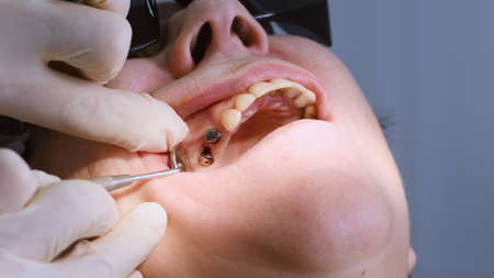 Oral surgeon shows installed dental implants into senior woman gum and jaw bone. Dentist and assistant work with a patient in modern dental clinicの写真素材