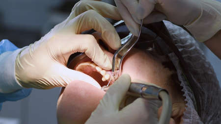 Oral surgeon drilling hole in senior woman gum and jaw bone before installing dental implant. Dentist with assistant work with a patient in modern dental clinicの写真素材