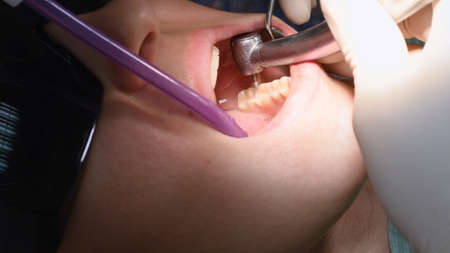Drilling teeth and sucking saliva with ejector. Young woman at dental clinic. Female dentist with assistant treating cavities in a patient mouth in modern dental office.の写真素材