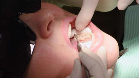 Applying resin based composite filling on tooth. Young woman at dental clinic. Female dentist with assistant treating cavities in a patient mouth in modern dental office.の写真素材