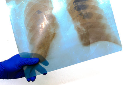 hand in blue rubber protective medical surgical glove holds x-ray of human lungs