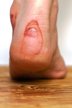 rubbed in the blood of the heel of a person from uncomfortable shoes concept medicine trauma. High...