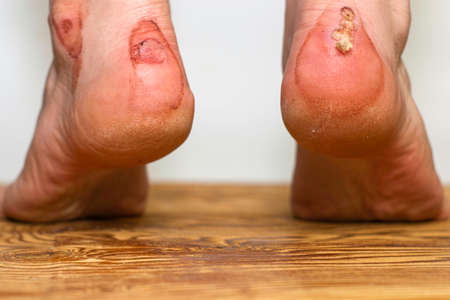 rubbed in the blood of the heels of a person from uncomfortable shoes the concept of medicine trauma. High quality photoの写真素材