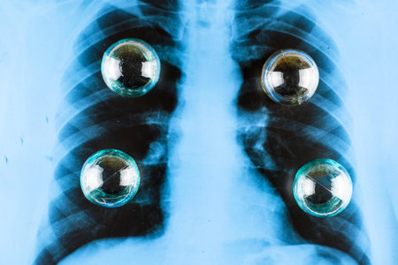 glass medical jars on the lung X-ray concept alternative medicine. High quality photo