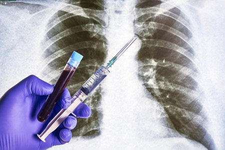a hand in a blue medical glove holds a test tube with a blood sample and a syringe with medicine against the background of an X-ray of the lungs. high quality photoの写真素材