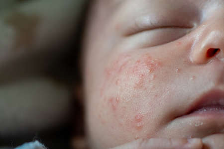 Close-up detail of the cheek of a newborn baby with neonatal acne. skin irritation with small red pimples, ezema or baby skin allergy. keratin accumulation, fatteningの写真素材