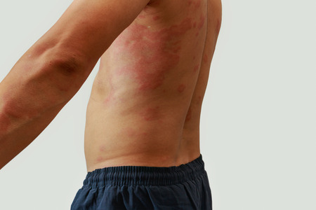 Man with dermatitis problem of rash ,Allergy rashの写真素材