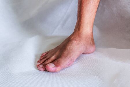 Foot is a fungal infectionの写真素材