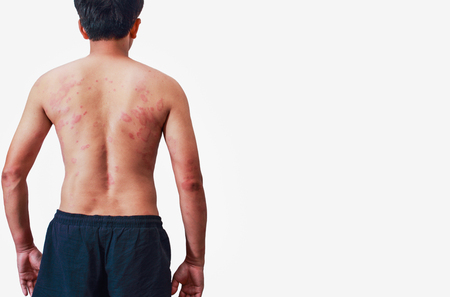 Around Back  of men with dermatitis problem of rash ,Allergy rashの写真素材