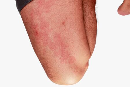 Leg area of men with dermatitis  of rash, allergy rash and Health problem on whiteの写真素材