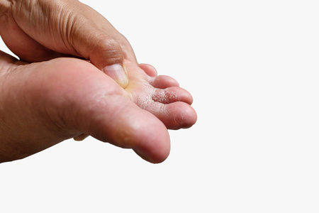 Men's toe is a fungus, Foot is a fungal infection with on white