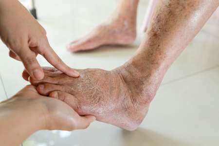 Hands of doctor or nurse examining the dry,cracked,swollen feet of old elderly people,skin care problems,senior woman with diabetes or kidney disease causing swollen legs,health care,medical conceptの写真素材