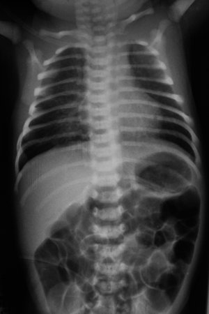 film x-ray whole infant\'s body