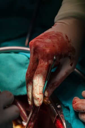 Heart surgery in operating roomの写真素材