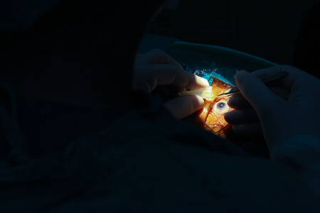 crystalline lens replaceable surgical methodの写真素材