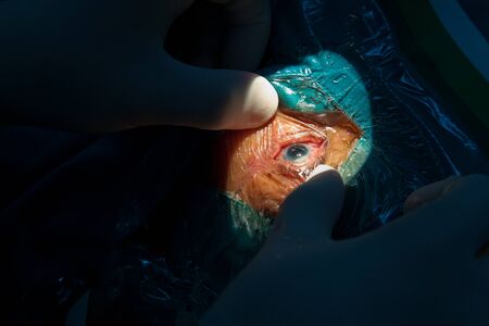 eye surgery - eye operationの写真素材