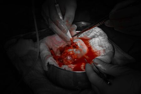 eye surgery - eye operationの写真素材