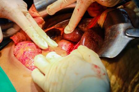 Patients and teamwork during liver surgery in the operating room.の写真素材